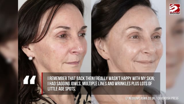 Strictly judge Shirley Ballas reveals she 'looks better than 10 years ago' following a non-surgical facelift
