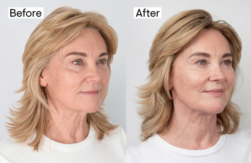 Anthea Turner shows off her incredible non-surgical facelift